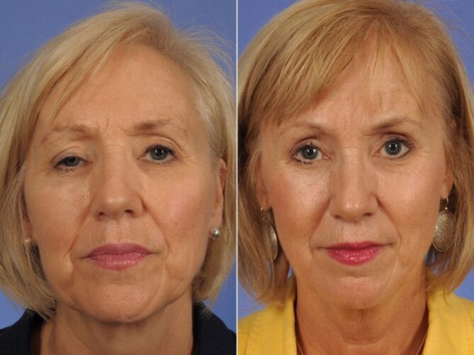 droopy-eyelids-ptosis-surgery-before-after-1-1024x766.jpg