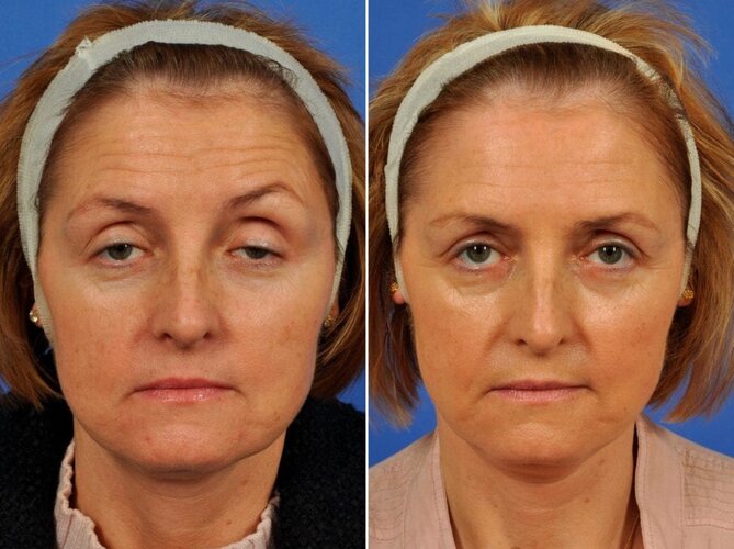 droopy-eyelids-ptosis-surgery-before-after-1-1024x766 (1).jpg