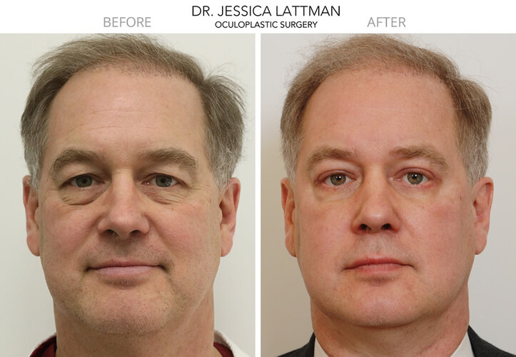 blepharoplasty3.jpg