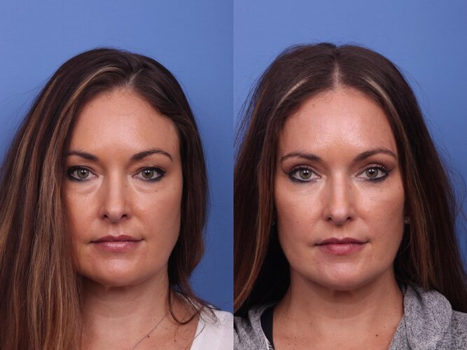 blepharoplasty-319-view-1-detail.jpg