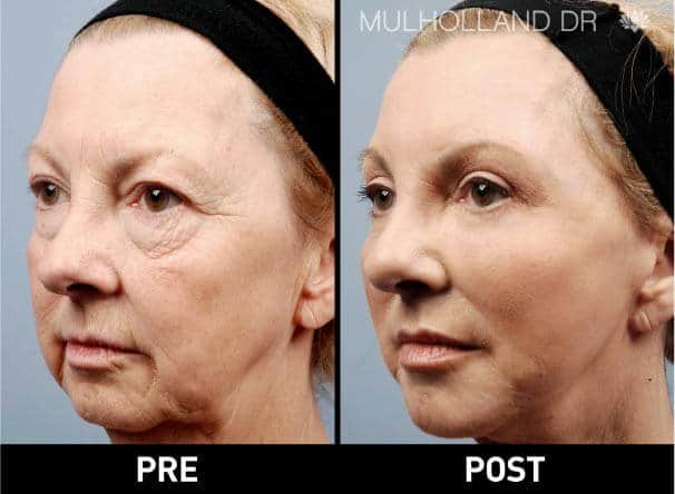 Image3 surgical facial fat transfer