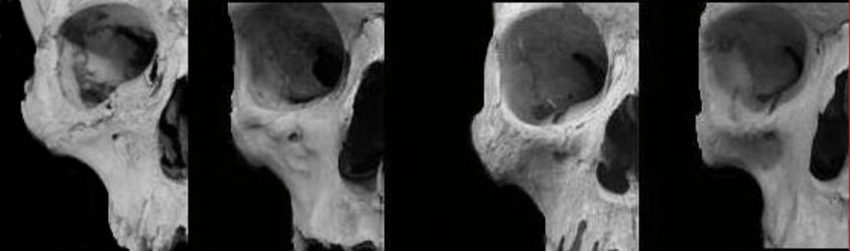 2355542 ariability of the canine fossa in current humans From left to right little expanded and