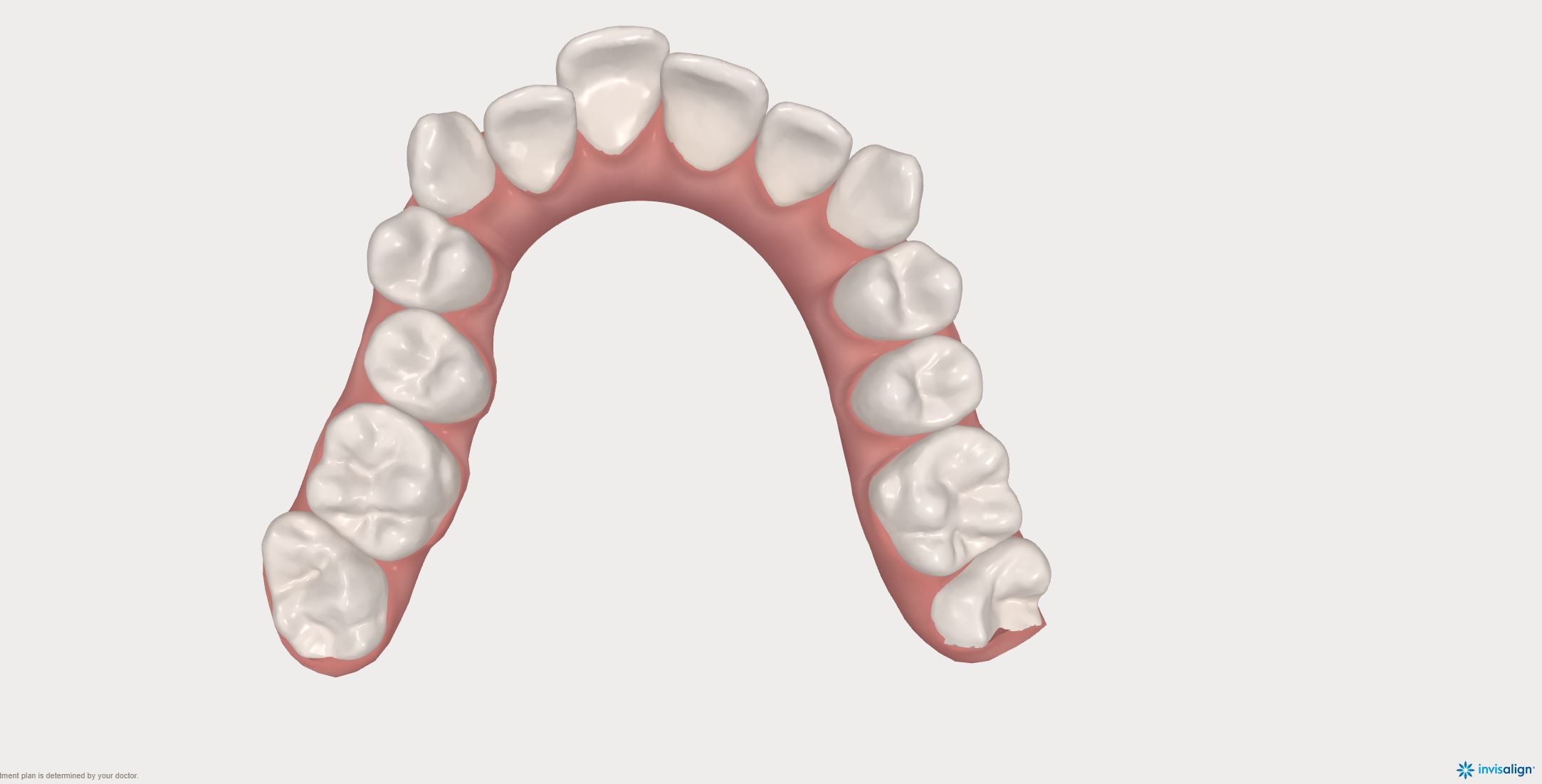 Mandible before