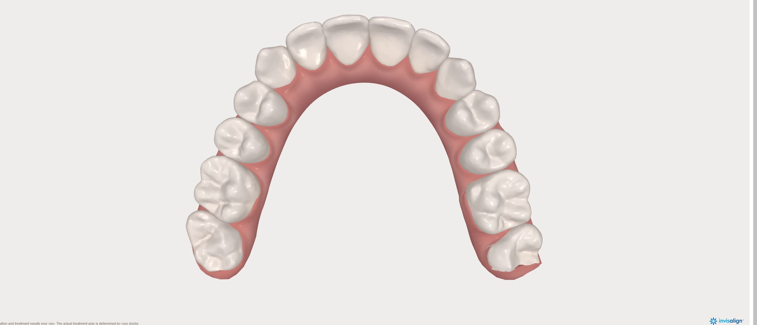 Mandible after