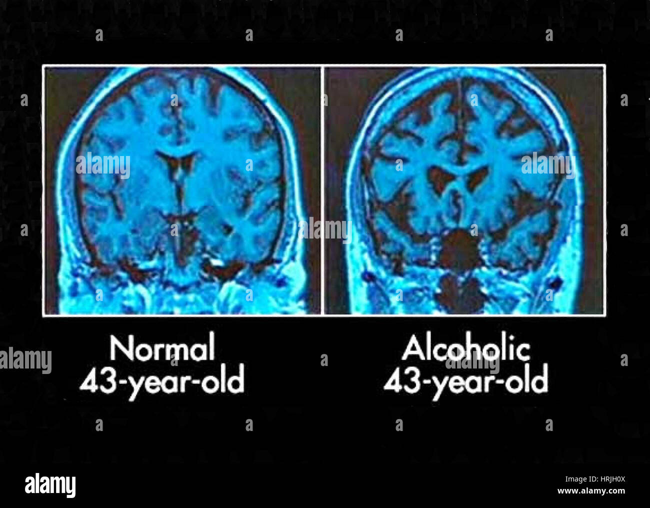 Normal and alcoholic brains mri scans HRJH0X
