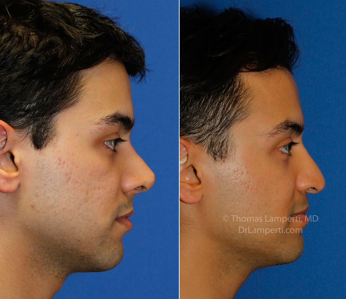 Revision rhinoplasty 15 r profile montage