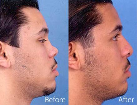 Patient 7887 upturned nose before after
