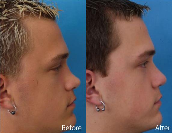 Patient 7891 upturned nose before after 2