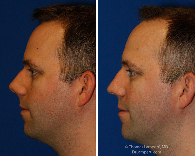 Rhinoplasty patient 55 l profile montage