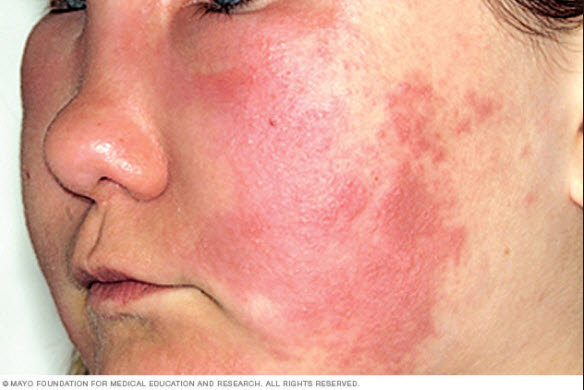 Hives 1