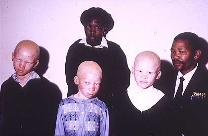 A black family with three children affected with albinism one affected with BOCA and two