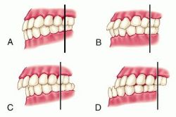 Malocclusion
