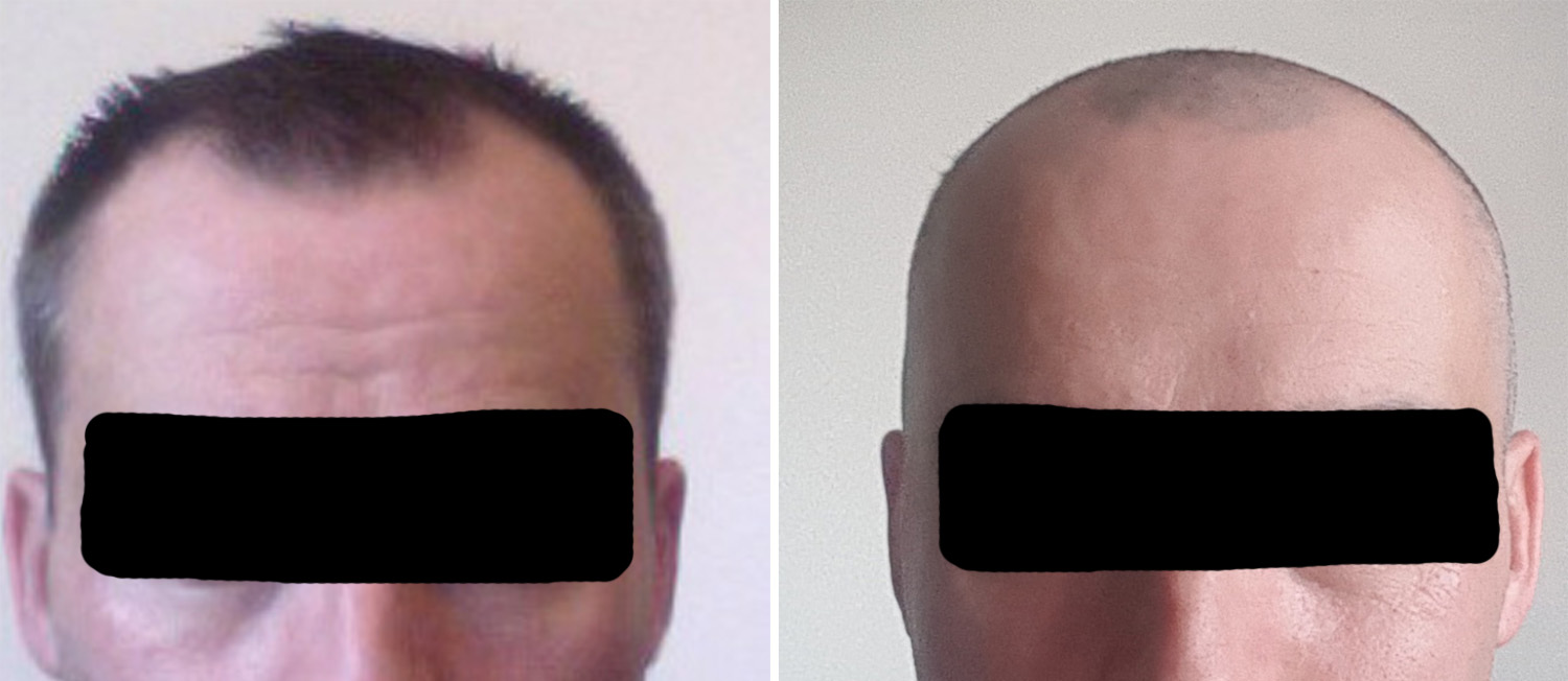 Posterior Temporal Reduction result front view Dr Barry Eppley Indianapolis
