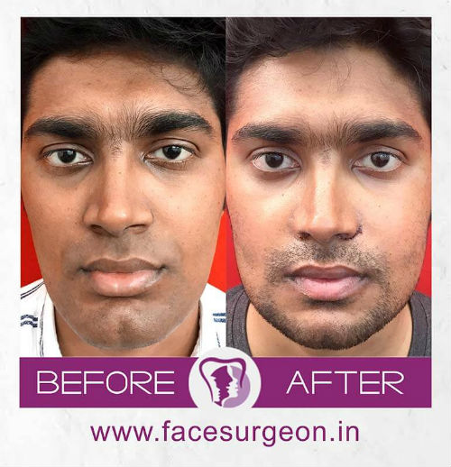 Jaw Surgery at Richardsons Hospital