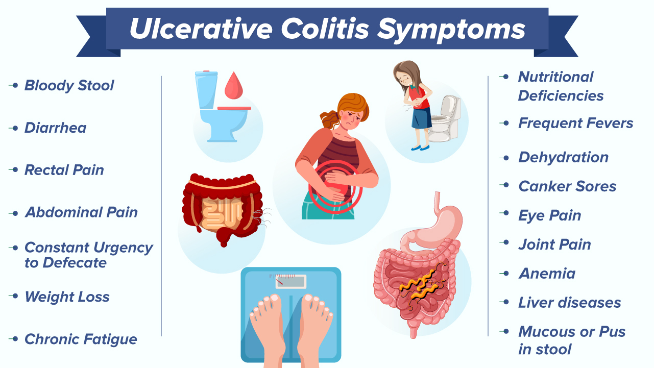 What is Ulcerative Colitis 2