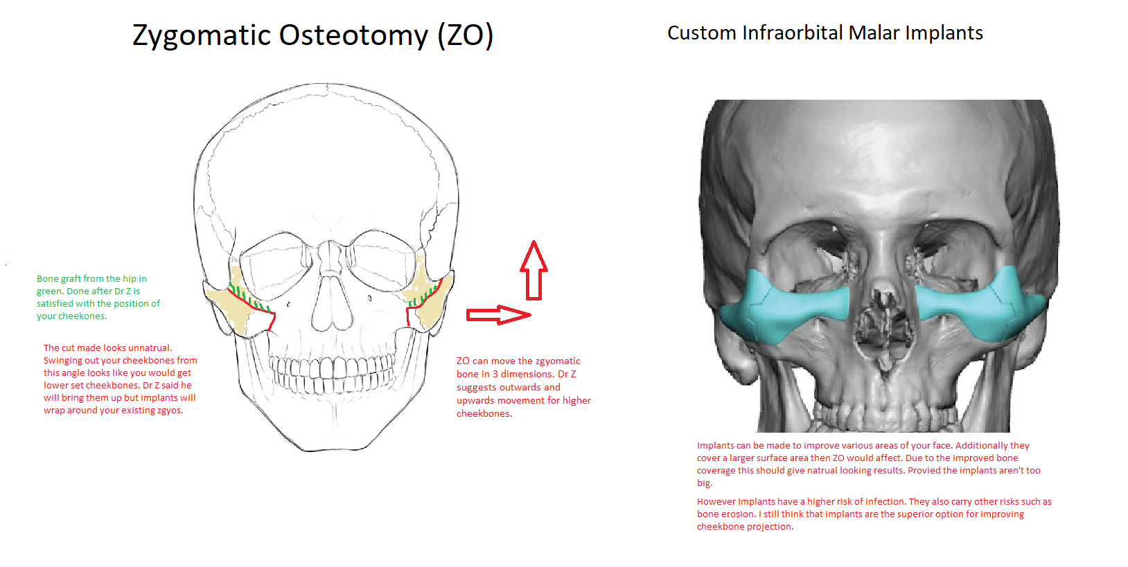 Zygomatic Osteotomy vs Implants