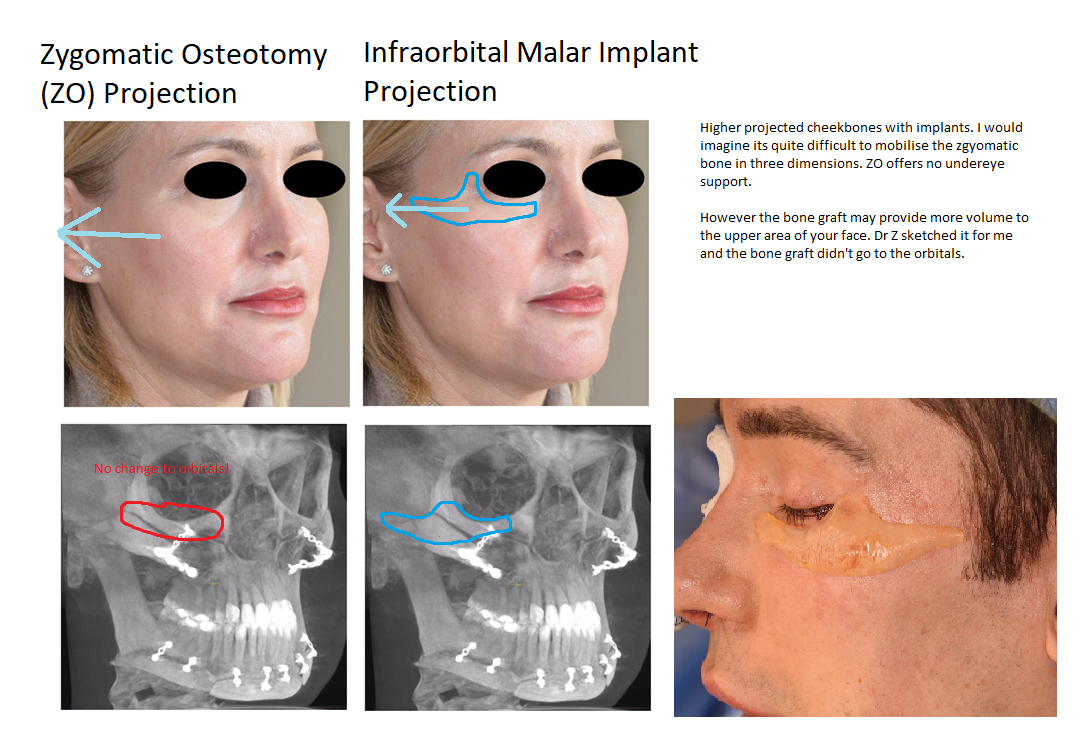 Zygomatic Osteotomy vs Infraorbital Malar Implants