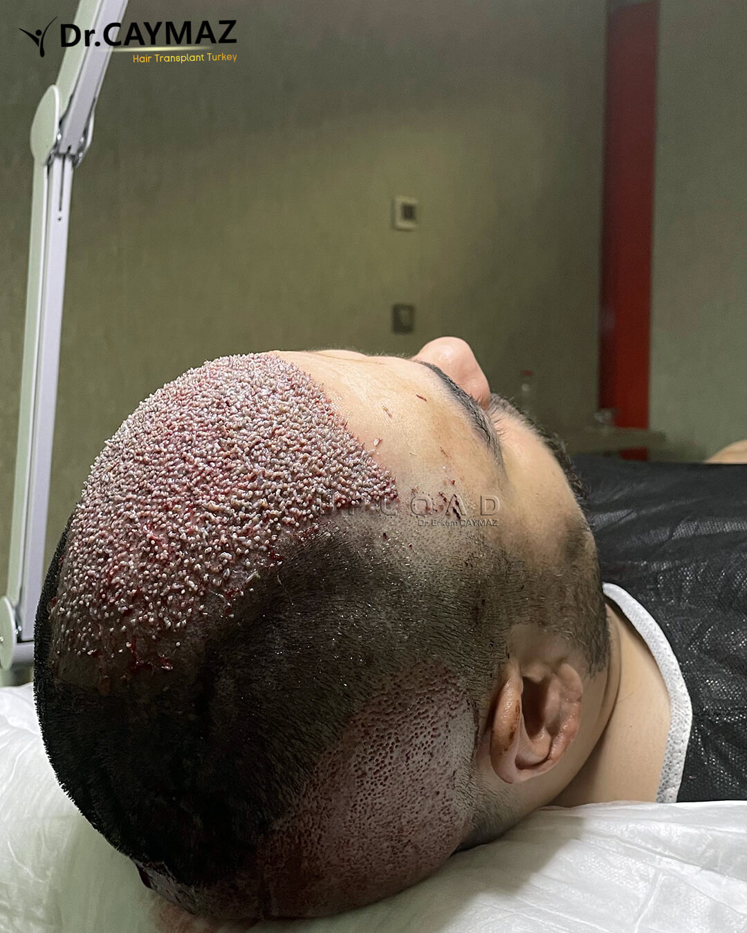 High Density Hair Transplantation 4400 Graft 2