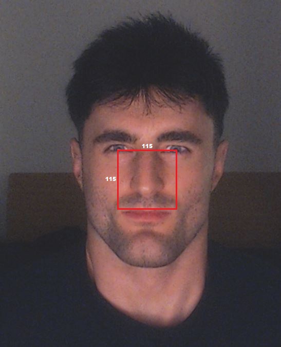 Midfaceratio