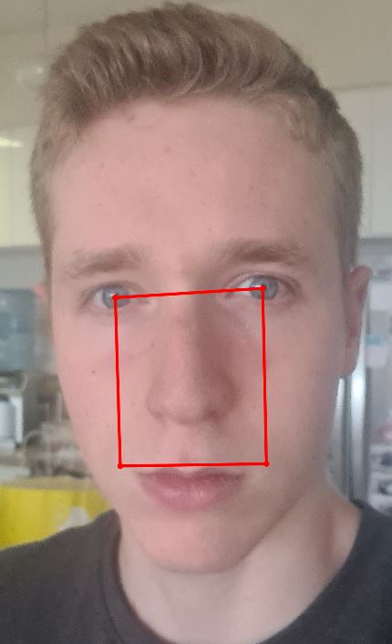 Midfaceratio Midfaceratio