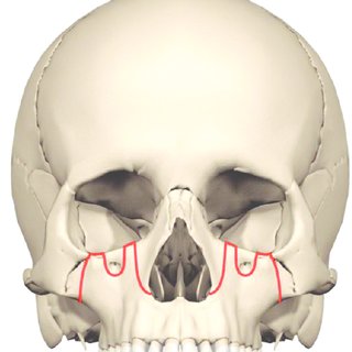 In some cases a high Le Fort I osteotomy is required for advancement of the entire Q320