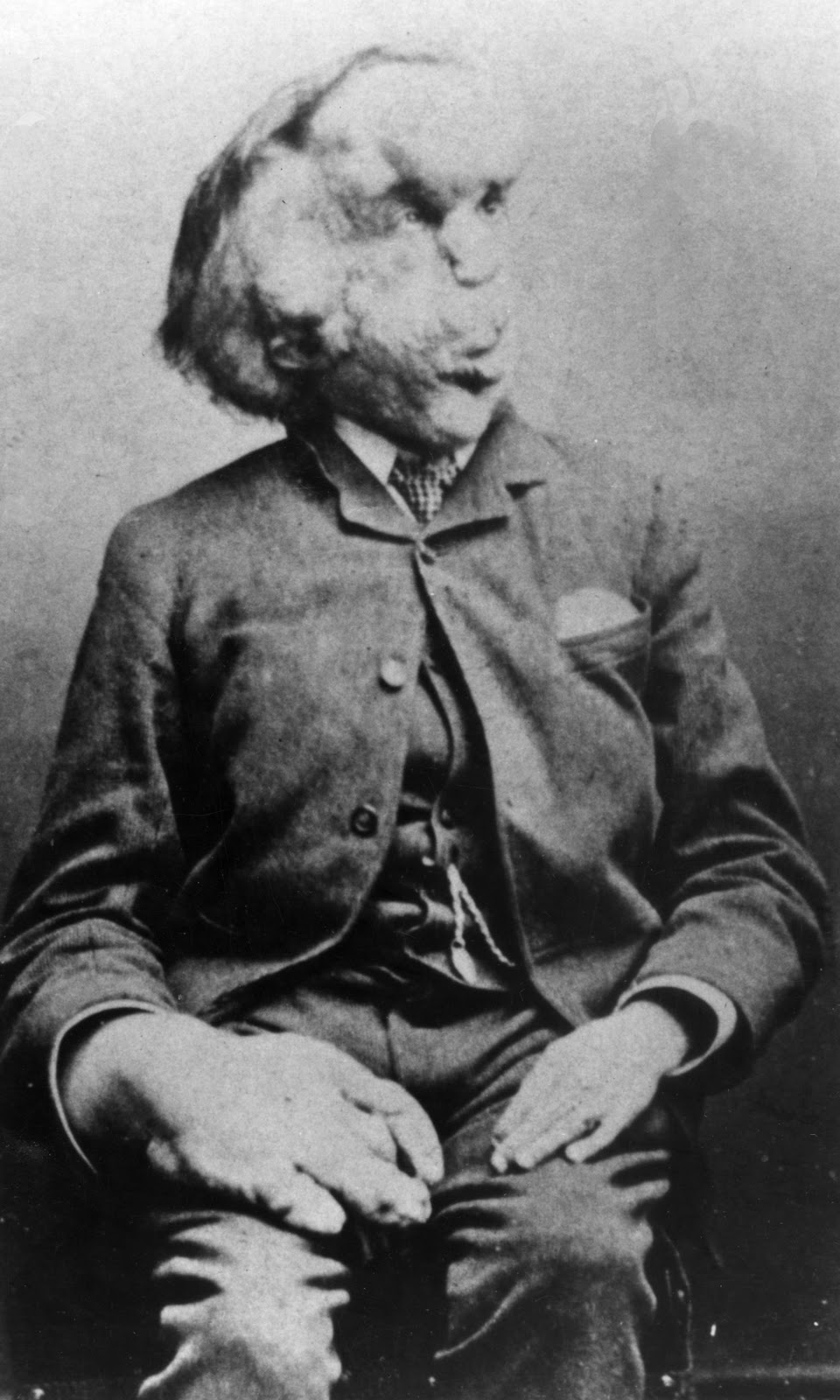 Joseph Merrick carte de visite photo c 1889