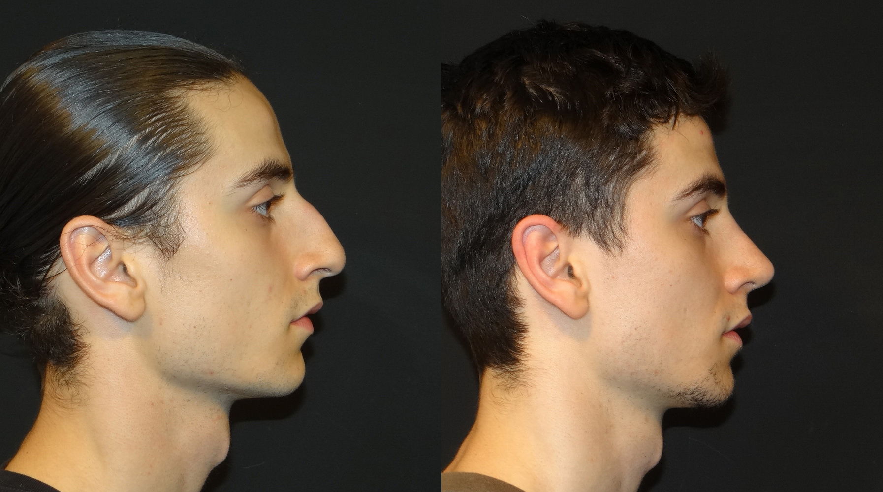 Male rhinoplasty May 2016 02 before after