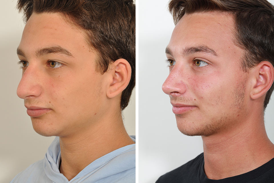 Rhinoplastyy 255