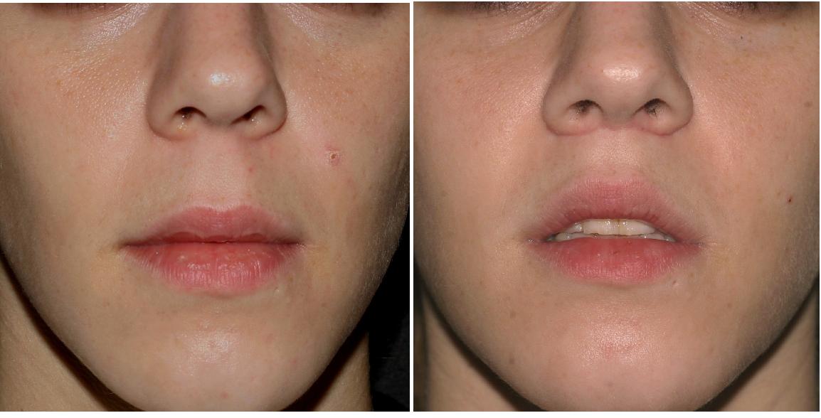 Lip Lift Before  After