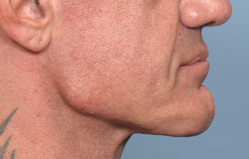 Male strong custom jawline implant right side 2 Dr Barry Eppley Indianapolis