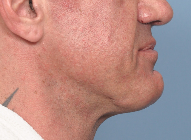 Msle strong custom jawline implant right side 1 Dr Barry Eppley Indianapolis