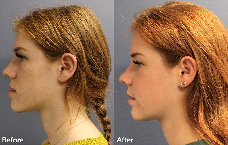 Orthognathic Surgery 1 1