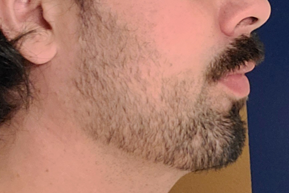 Male custom jawline implamnt for short jaw side after Dr Barry Eppley Indianapolis