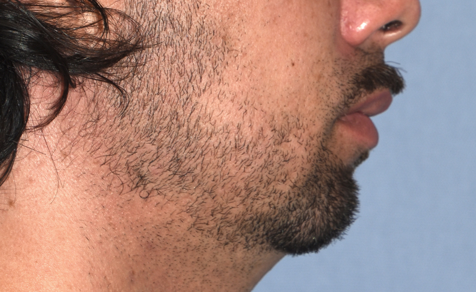 Male custom jawline implant for short jaw side before Dr Barry Eppley Indianapolis 