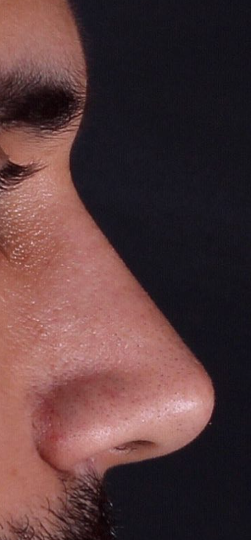 Suleyman tas male rhinoplasty 2