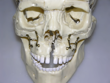 Complete Le Fort I osteotomy for palatal distraction and maxilla repositioning and
