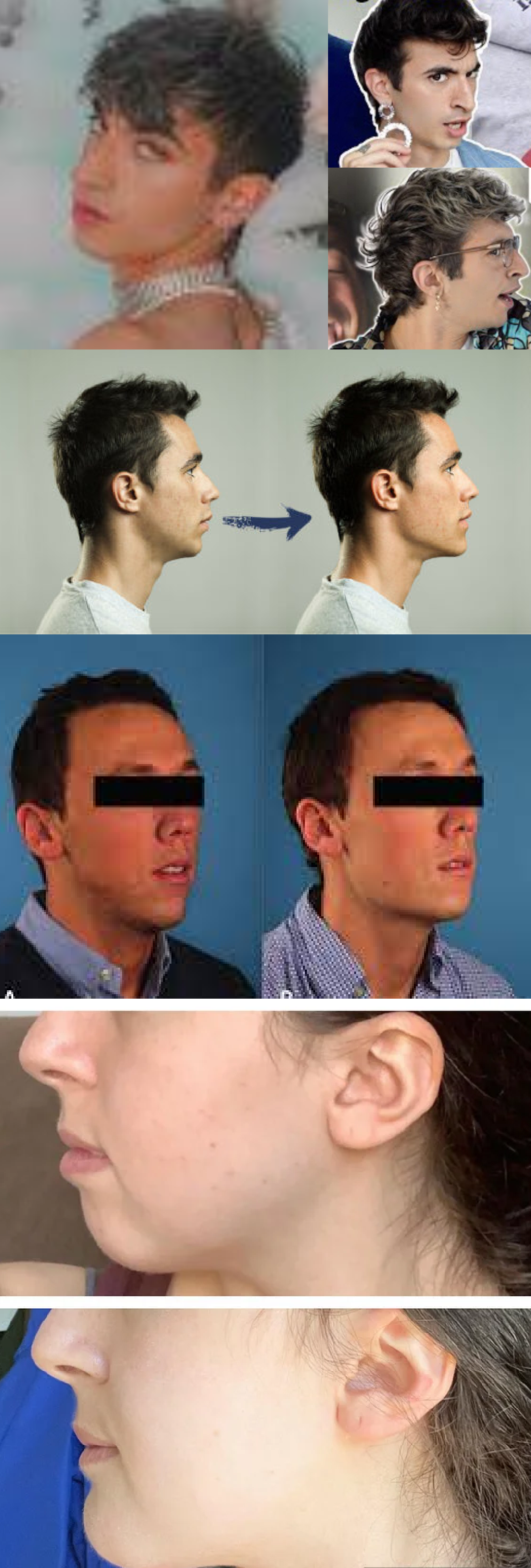 Chin angle