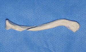 Oblique osteotomy cut of clavicle with lengthening Dr Barry Eppley Indianapolis 300x182