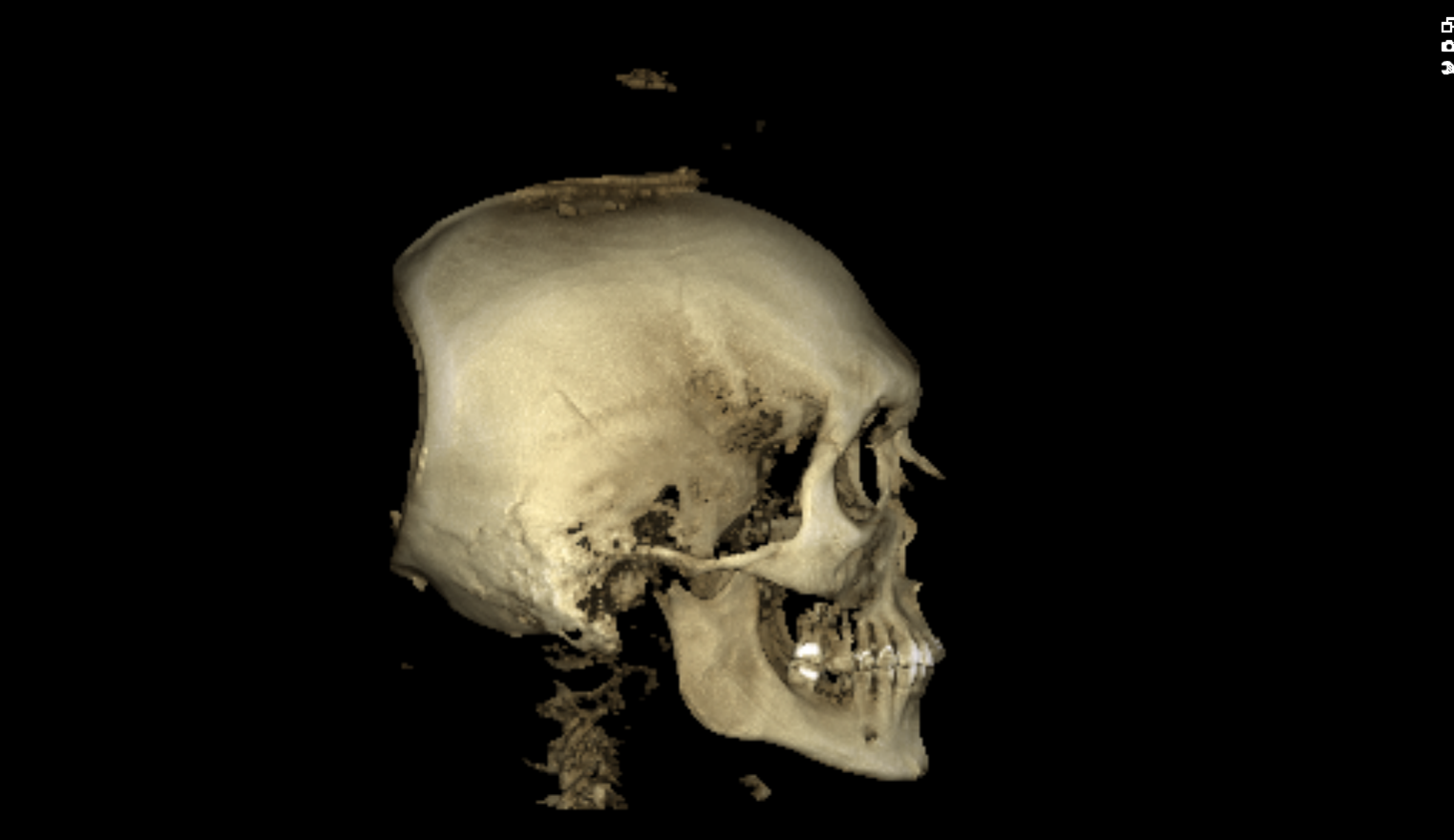 Ct scan side 2