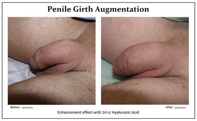 Penile Girth Augementation