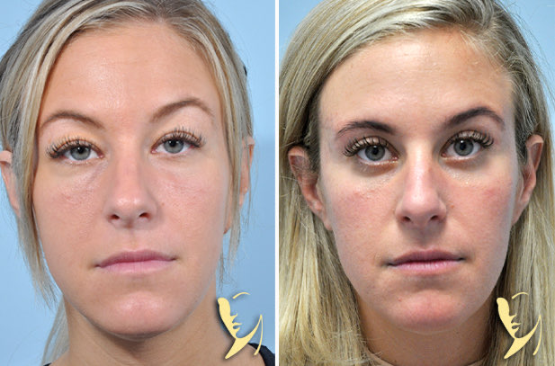 Eyelid fat removal