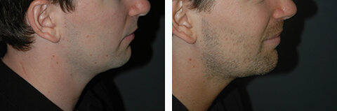 chin-implant-before-and-after-photos.jpg