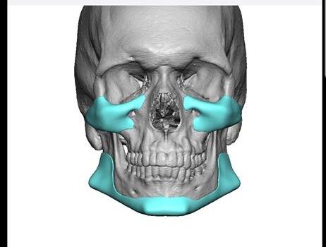 Implants cheek x1 design