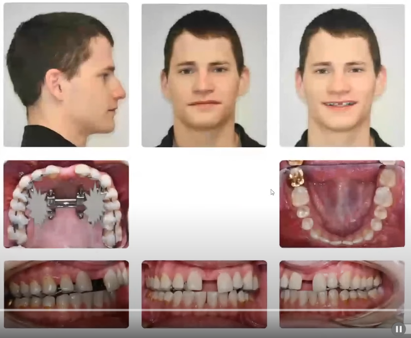 Palate MSE 2