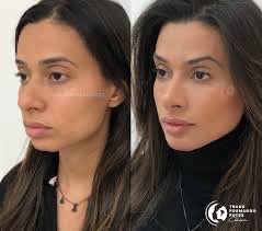 Brazilianfiller
