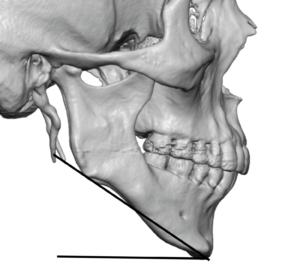 High Jaw Angle Jaw Shape Dr Barry Eppley Indianapolis 300x277