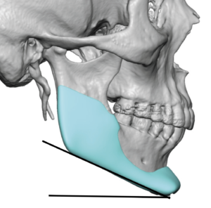 Implant Corrected High Jaw Angle Jaw Shape Dr Barry Eppley Indianapolis 300x296