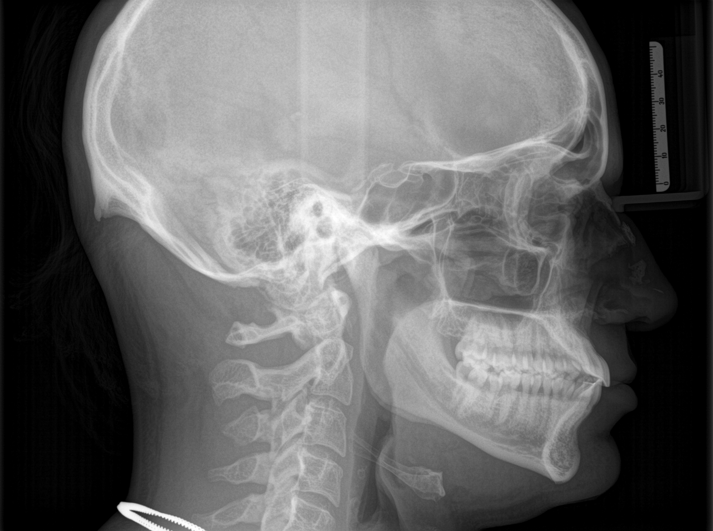 Profile X Ray Profile X Ray