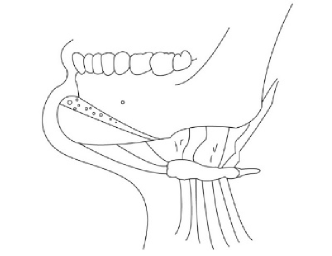 Sliding Genioplasty The genial osteotomy should involve the anterior inferior border of