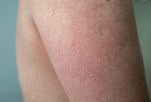 Keratosis pilaris example